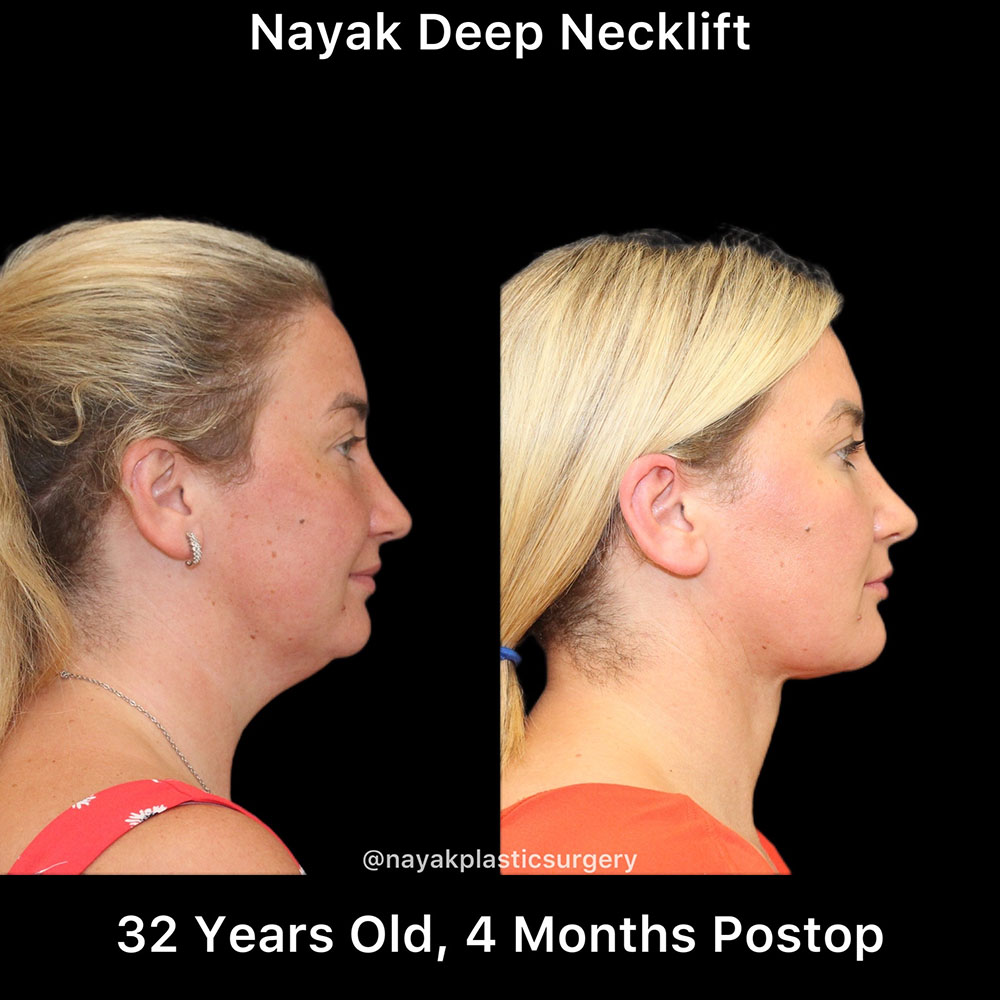 Deep Necklift Before & After Image