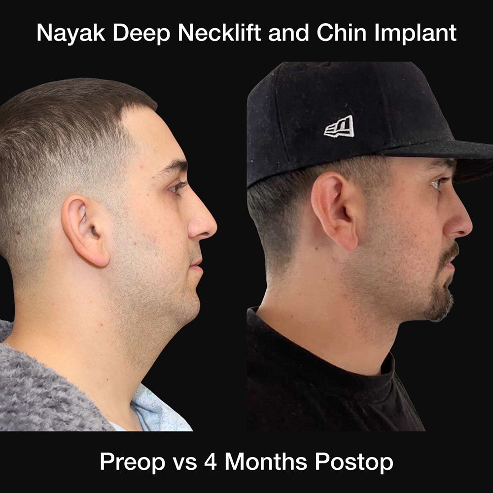 Deep Necklift Before & After Image