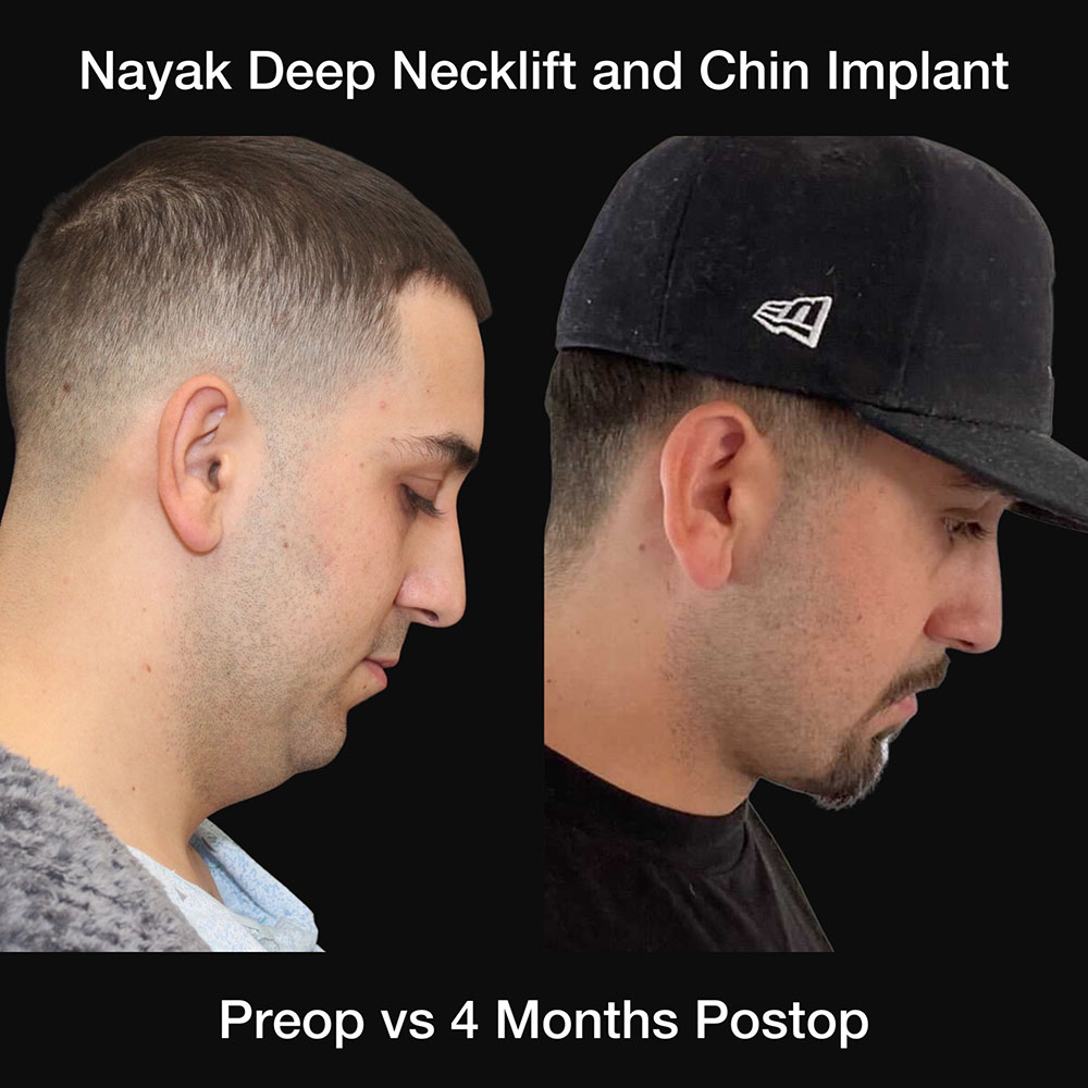 Deep Necklift Before & After Image