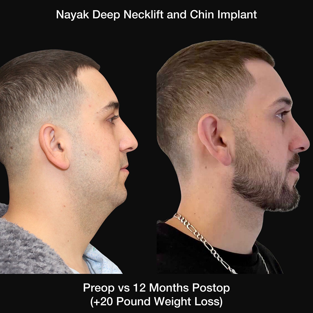 Deep Necklift Before & After Image