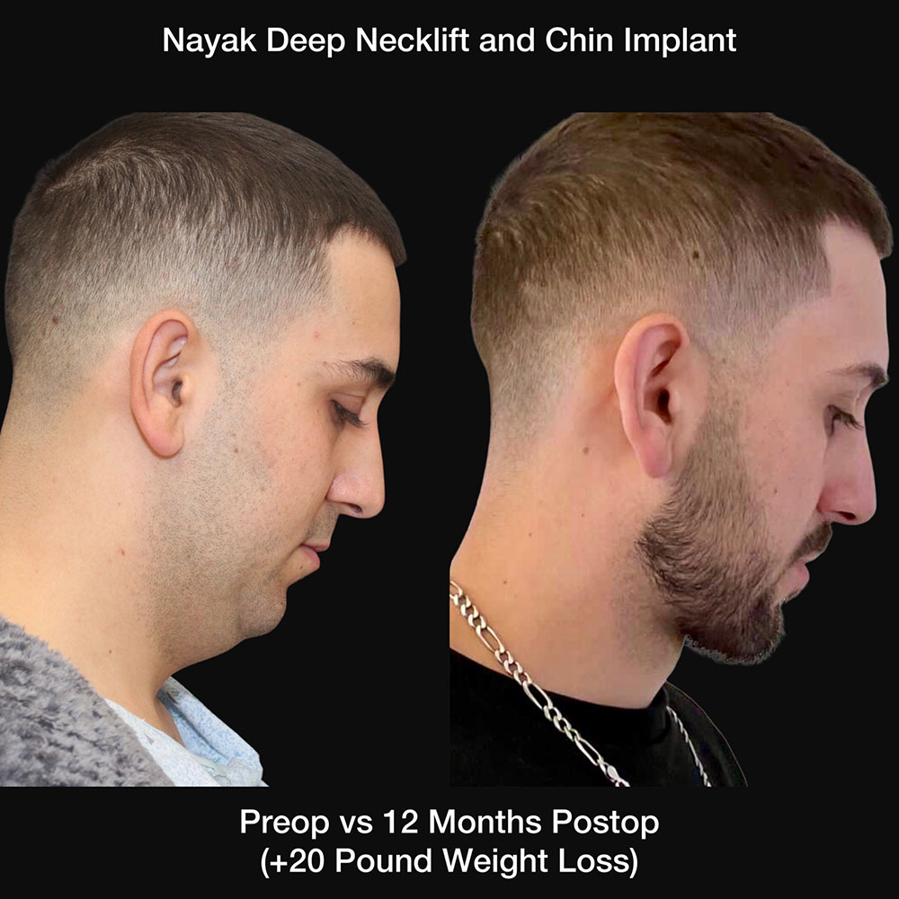 Deep Necklift Before & After Image