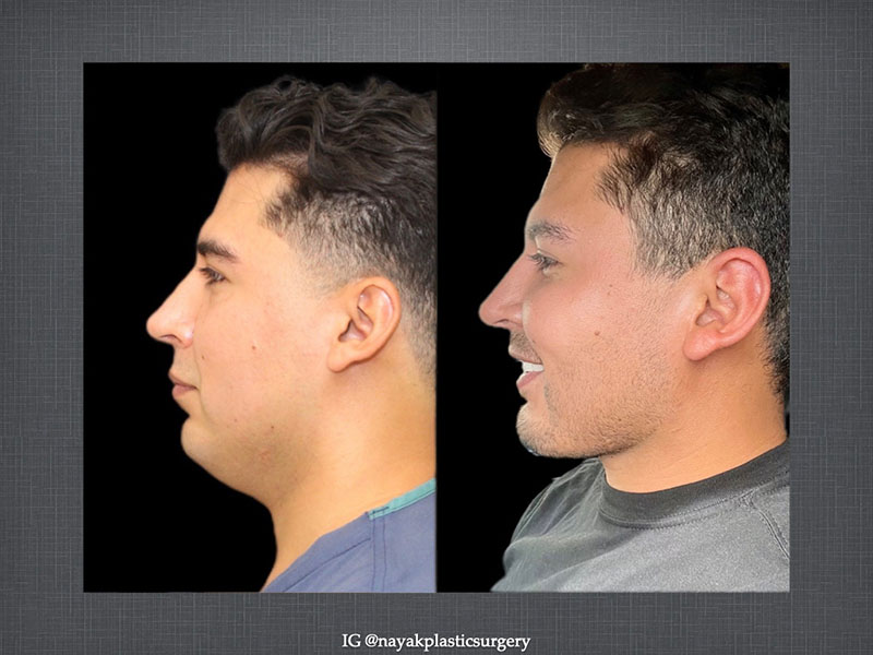 Deep Necklift Before & After Image