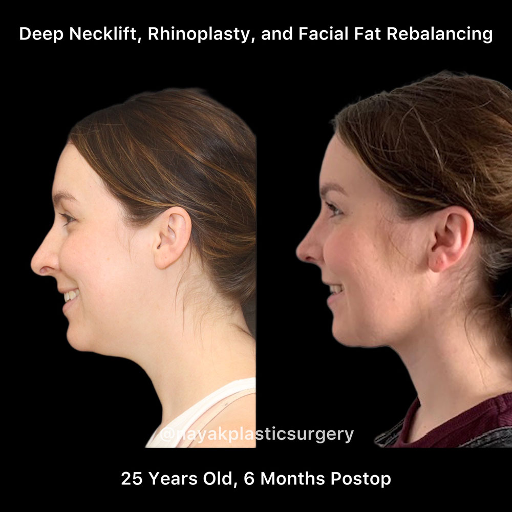 Deep Necklift Before & After Image