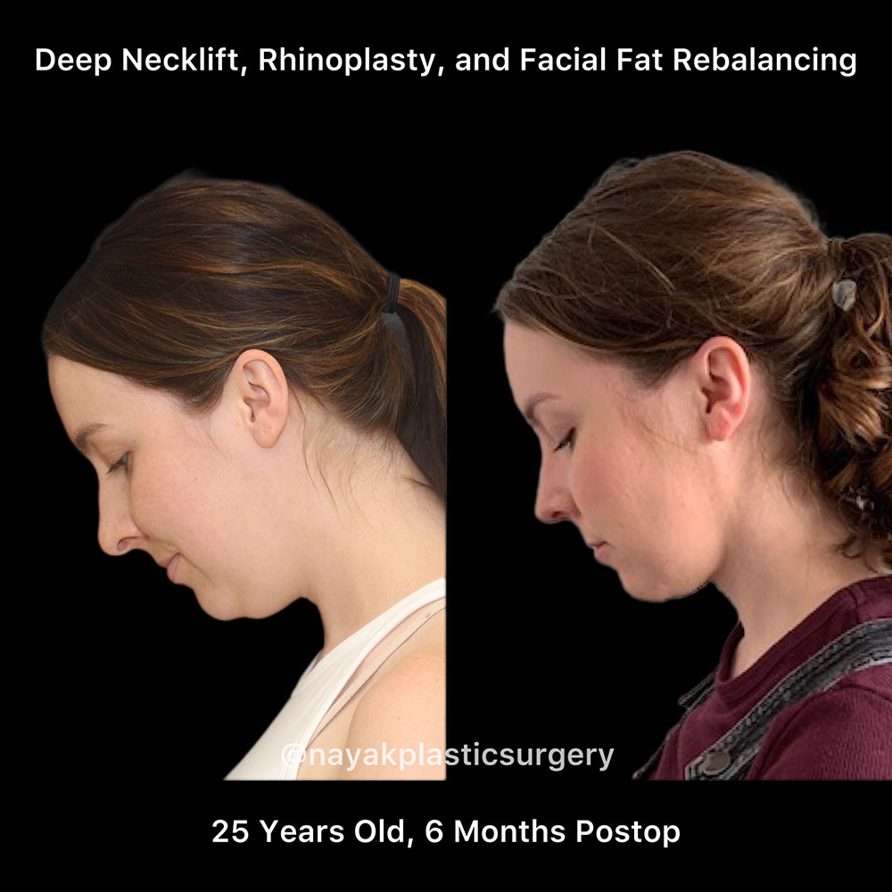 Deep Necklift Before & After Image