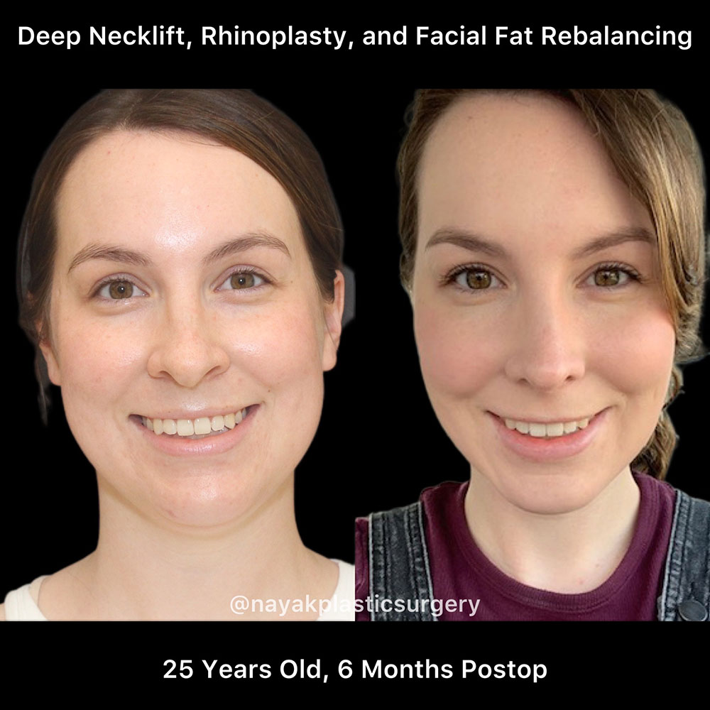 Deep Necklift Before & After Image