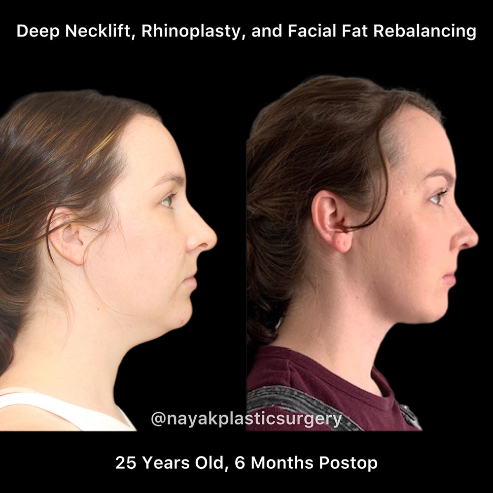 Deep Necklift Before & After Image