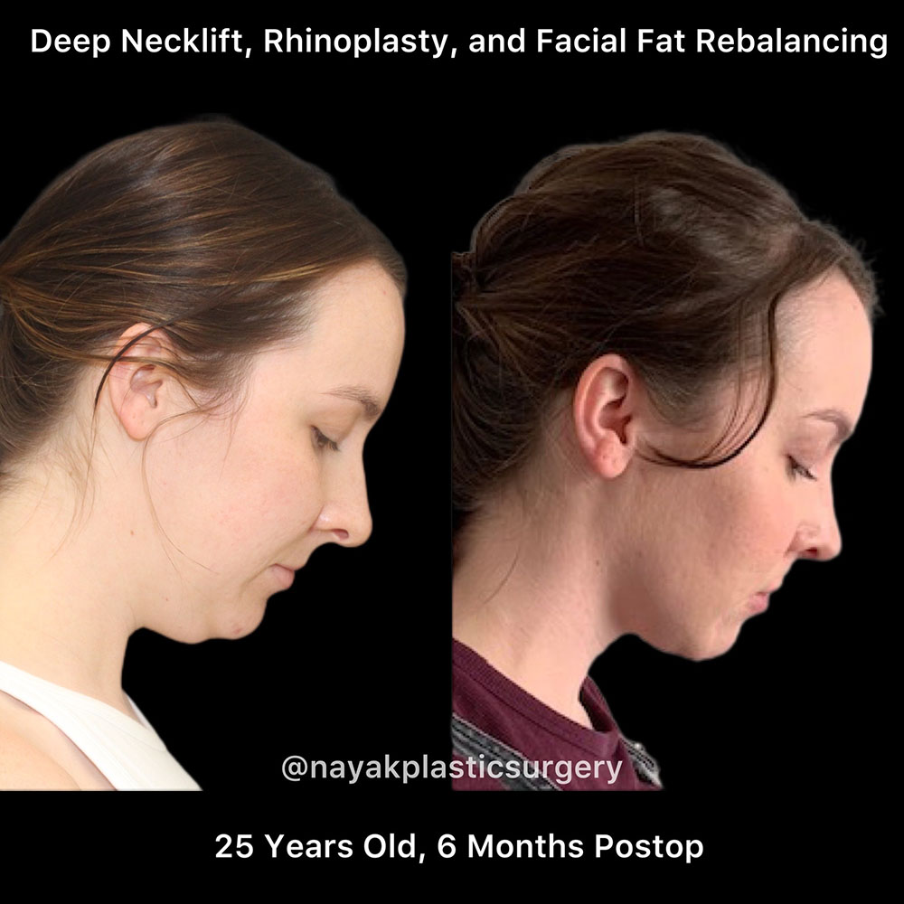 Deep Necklift Before & After Image