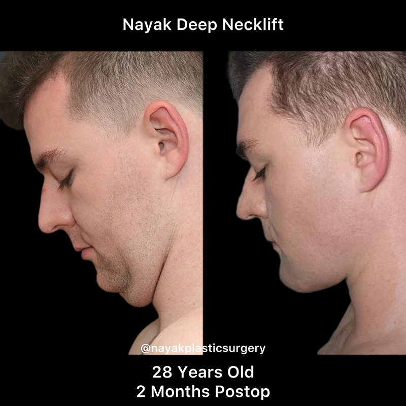 Deep Necklift Before & After Image