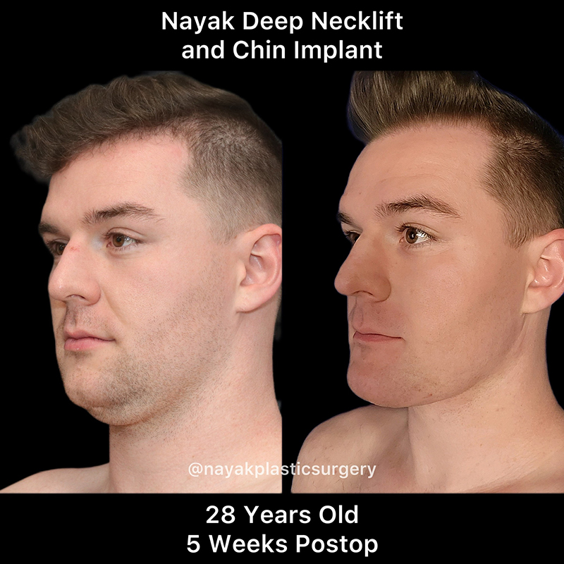 Deep Necklift Before & After Image