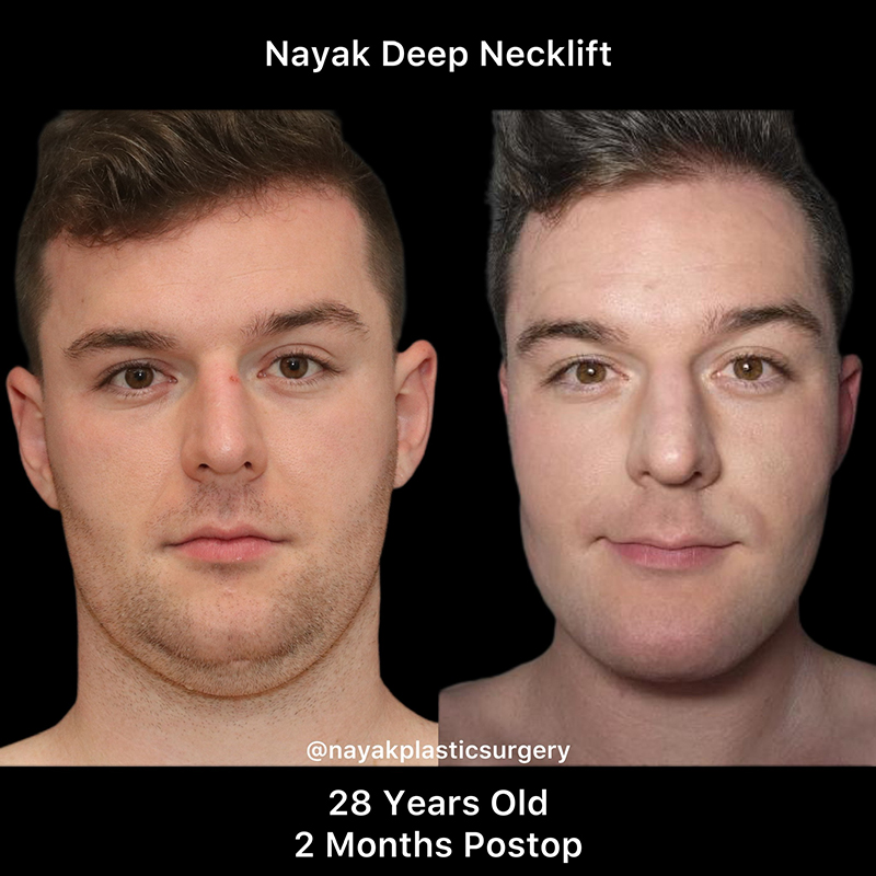 Deep Necklift Before & After Image