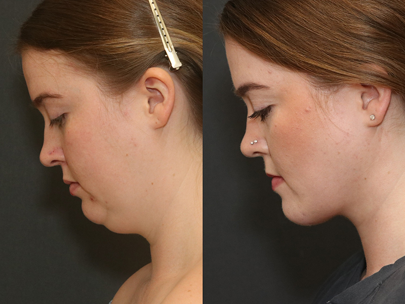 Deep Necklift Before & After Image