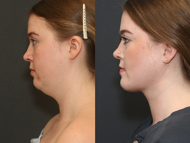 Deep Necklift Before & After Image