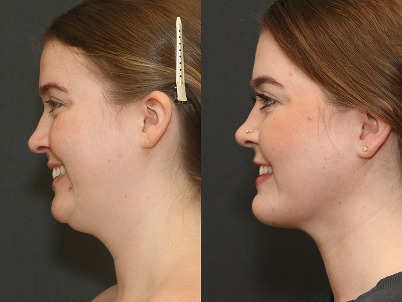 Deep Necklift Before & After Image