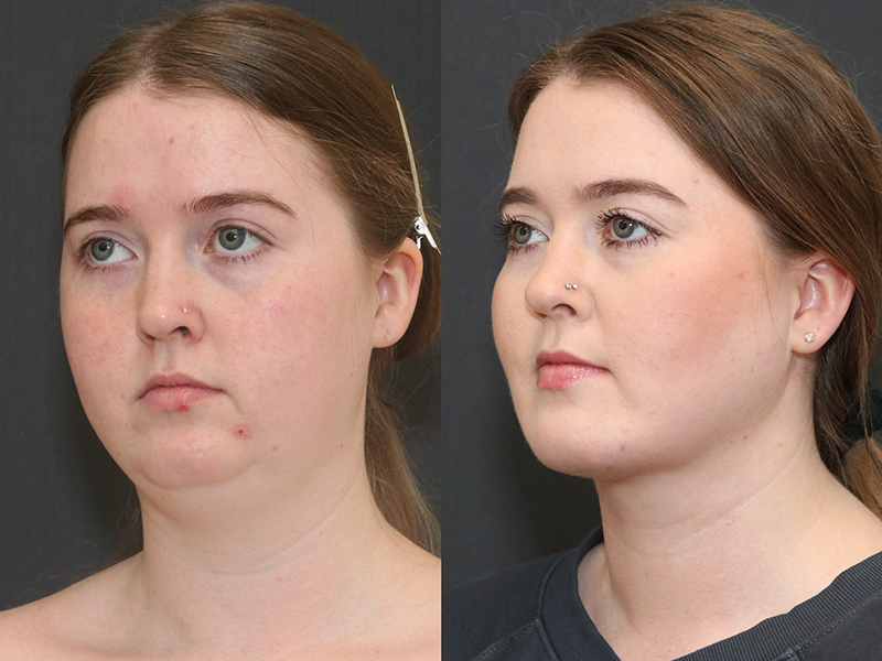 Deep Necklift Before & After Image