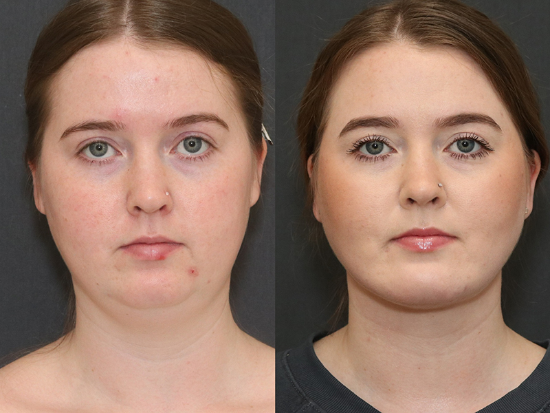 Deep Necklift Before & After Image