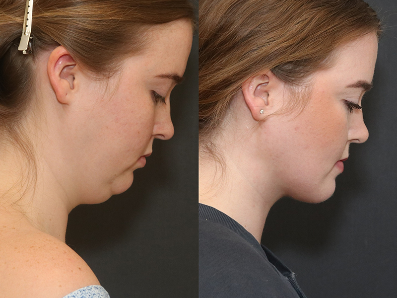 Deep Necklift Before & After Image