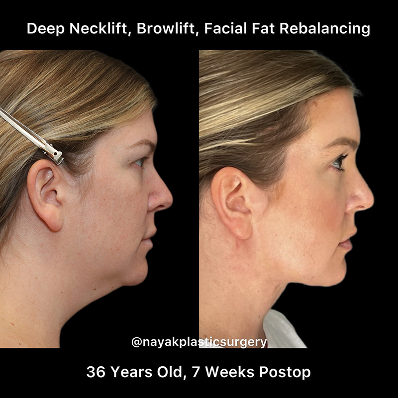 Deep Necklift Before & After Image