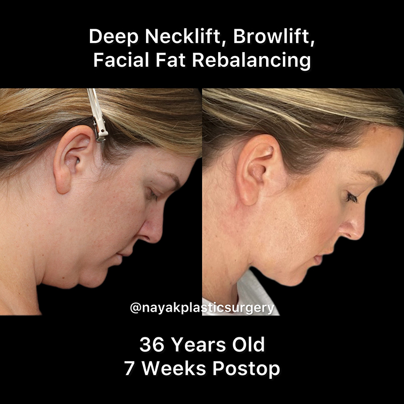 Deep Necklift Before & After Image