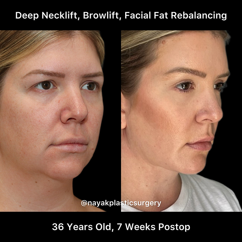 Deep Necklift Before & After Image