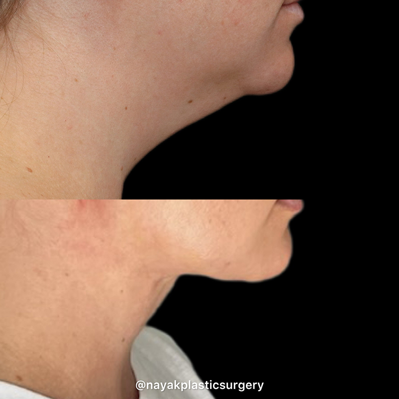 Deep Necklift Before & After Image