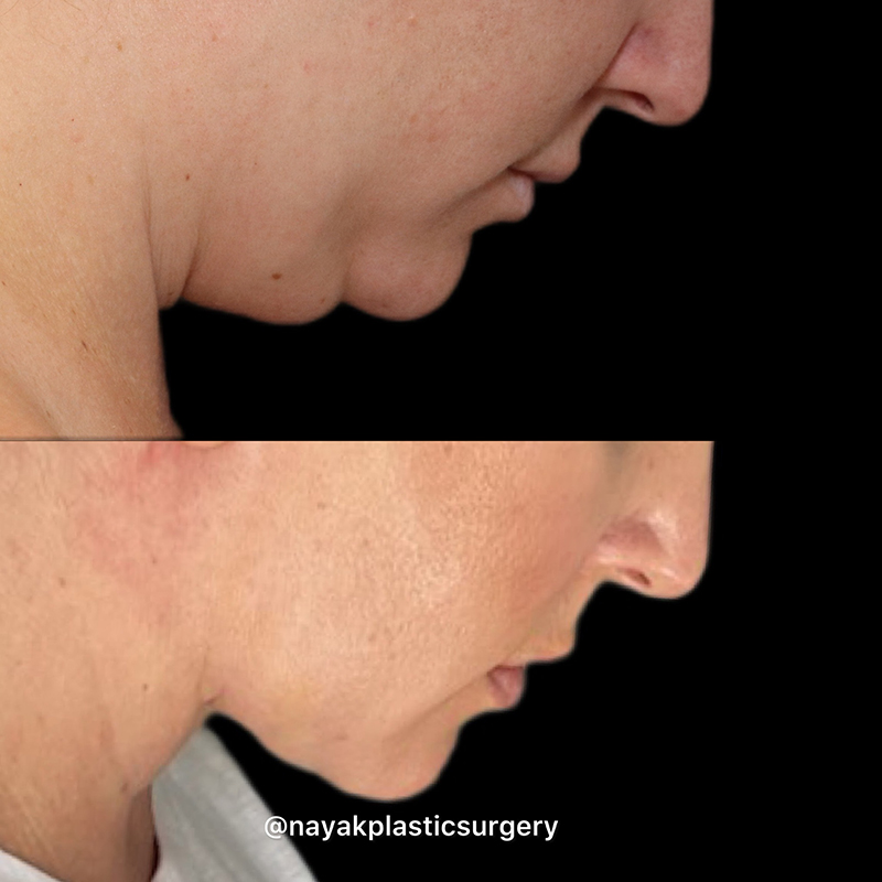 Deep Necklift Before & After Image