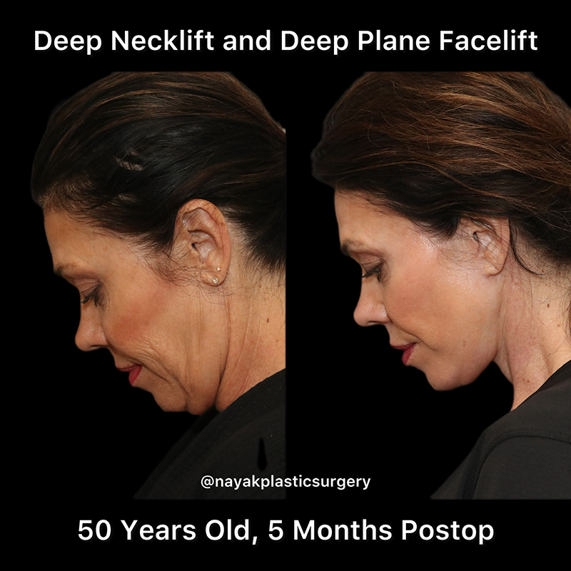 Deep Necklift Before & After Image