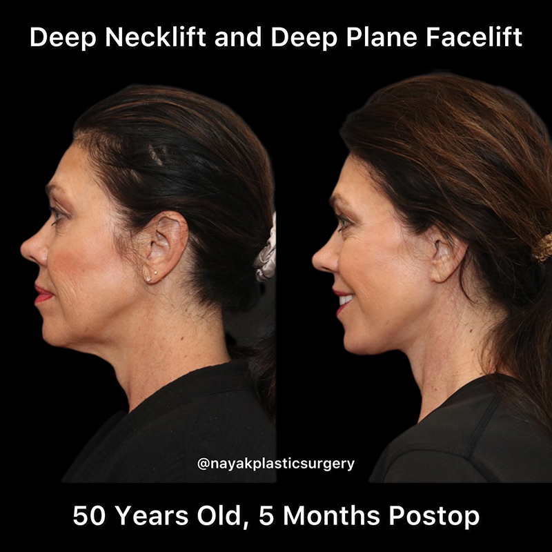 Deep Necklift Before & After Image