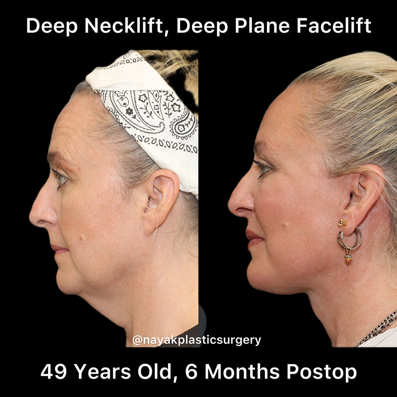 Deep Necklift Before & After Image