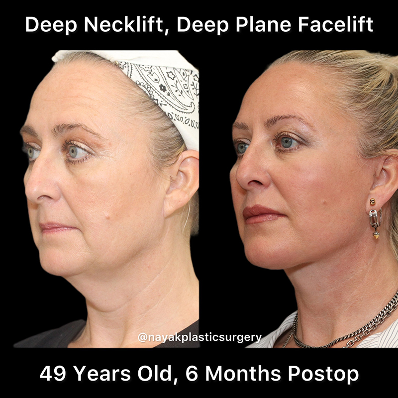 Deep Necklift Before & After Image