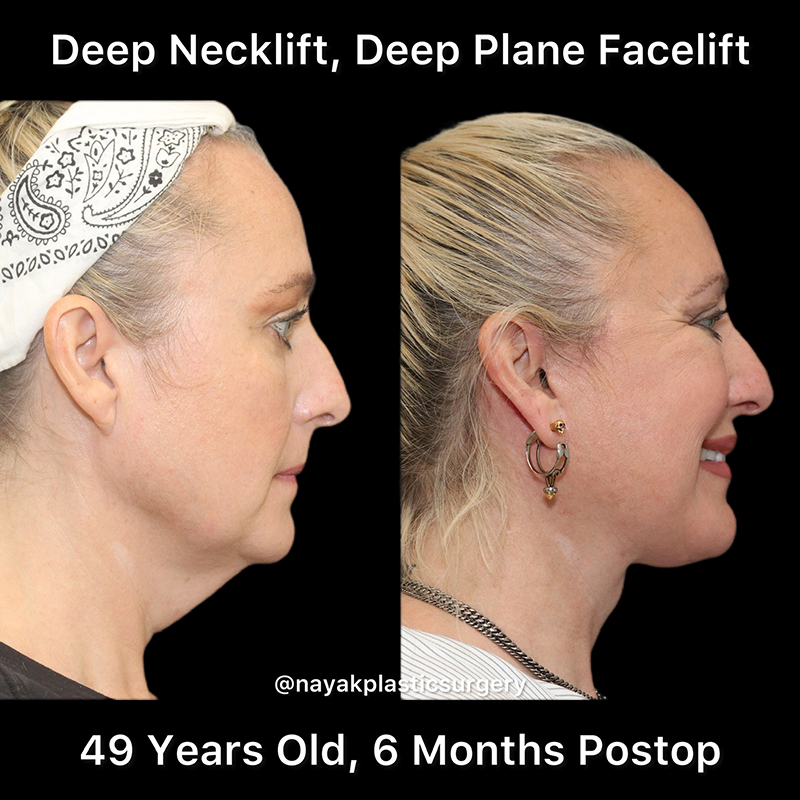 Deep Necklift Before & After Image