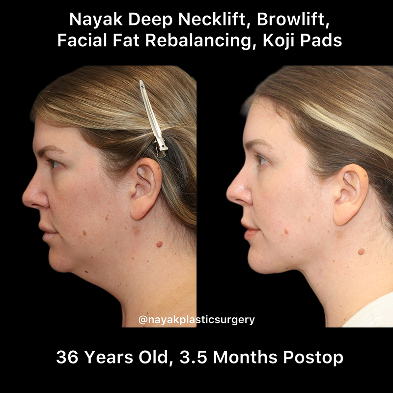 Deep Necklift Before & After Image