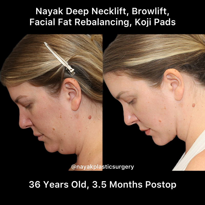 Deep Necklift Before & After Image