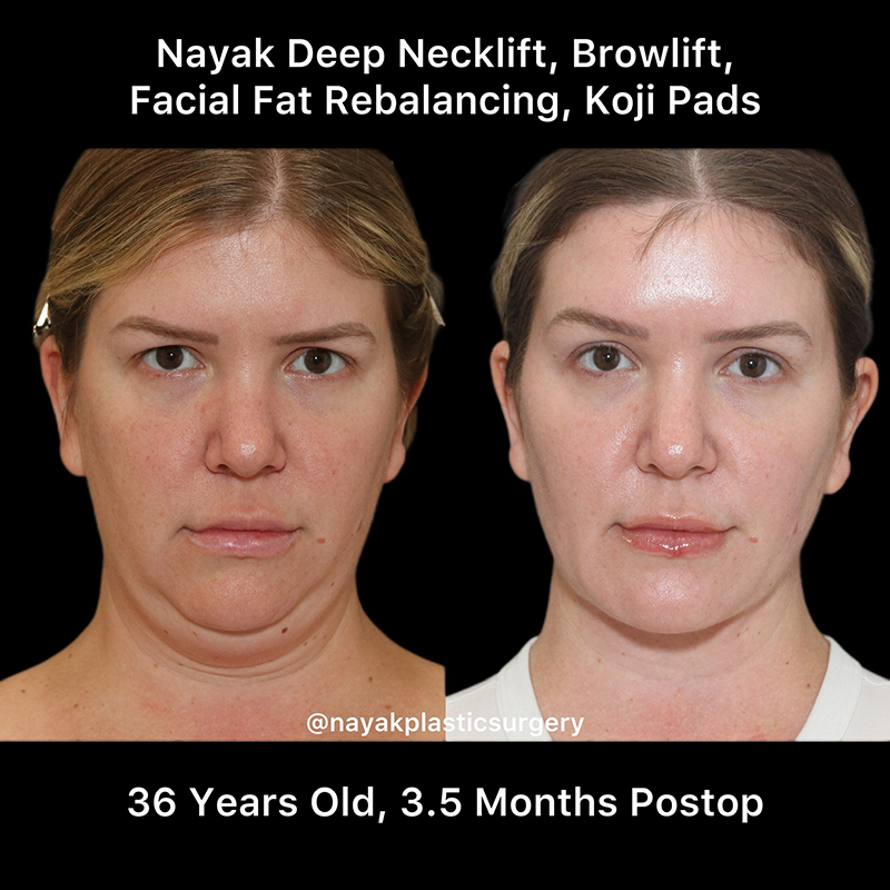 Deep Necklift Before & After Image