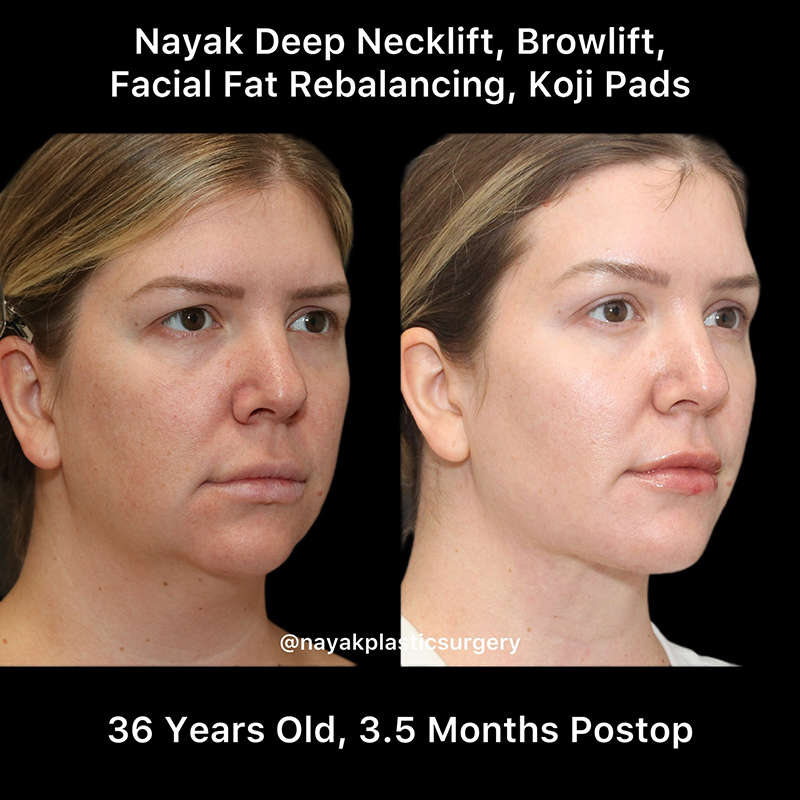 Deep Necklift Before & After Image