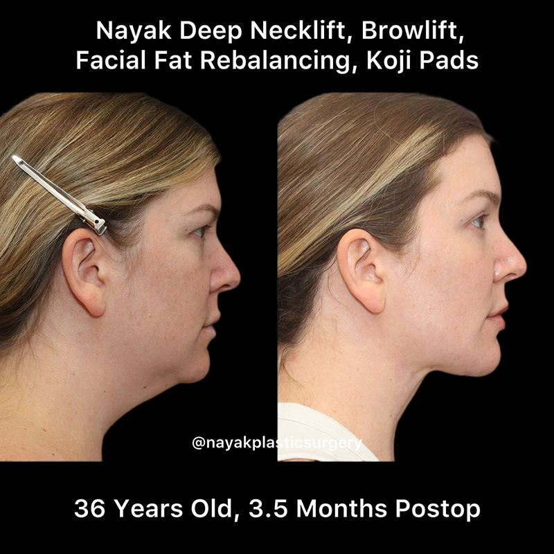 Deep Necklift Before & After Image