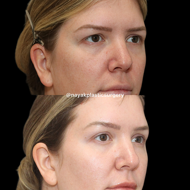 Deep Necklift Before & After Image