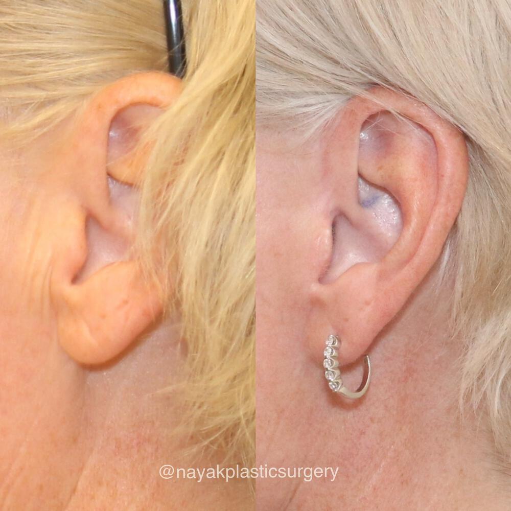 Otoplasty Before & After Image