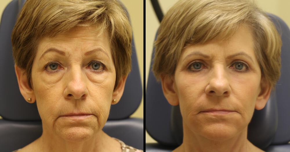 Blepharoplasty Before & After Image