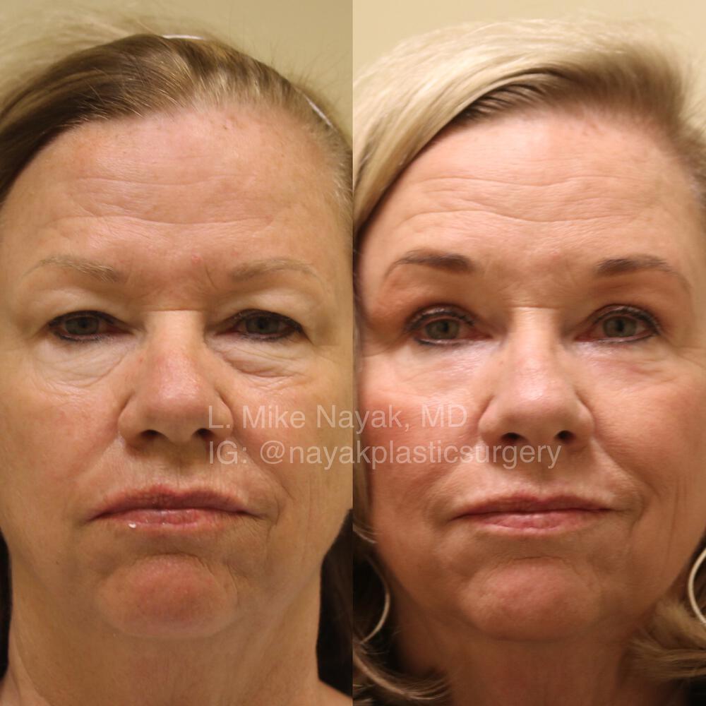 Blepharoplasty Before & After Image