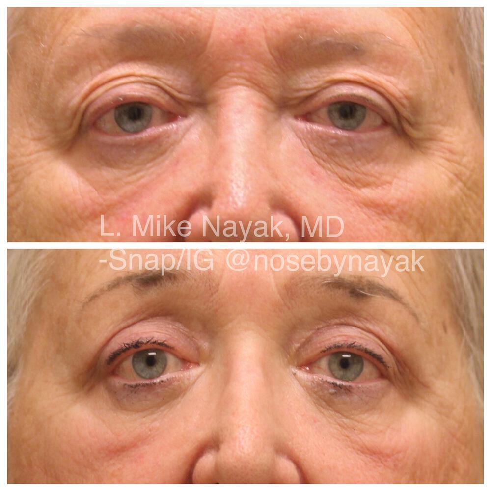 Blepharoplasty Before & After Image