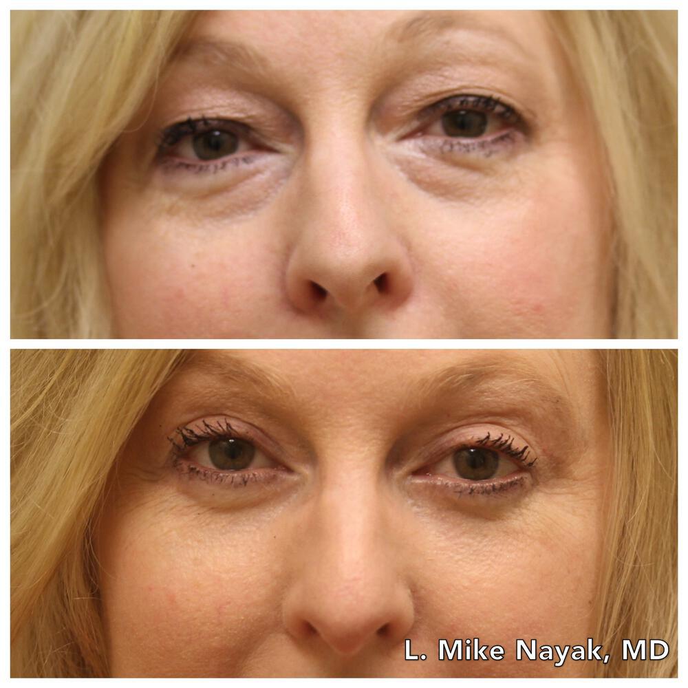 Blepharoplasty Before & After Image