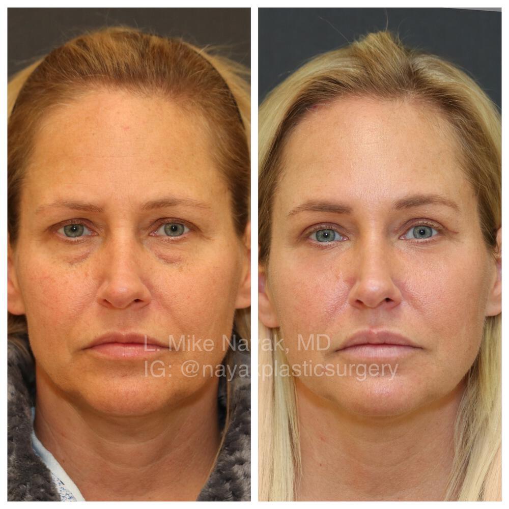 Blepharoplasty Before & After Image