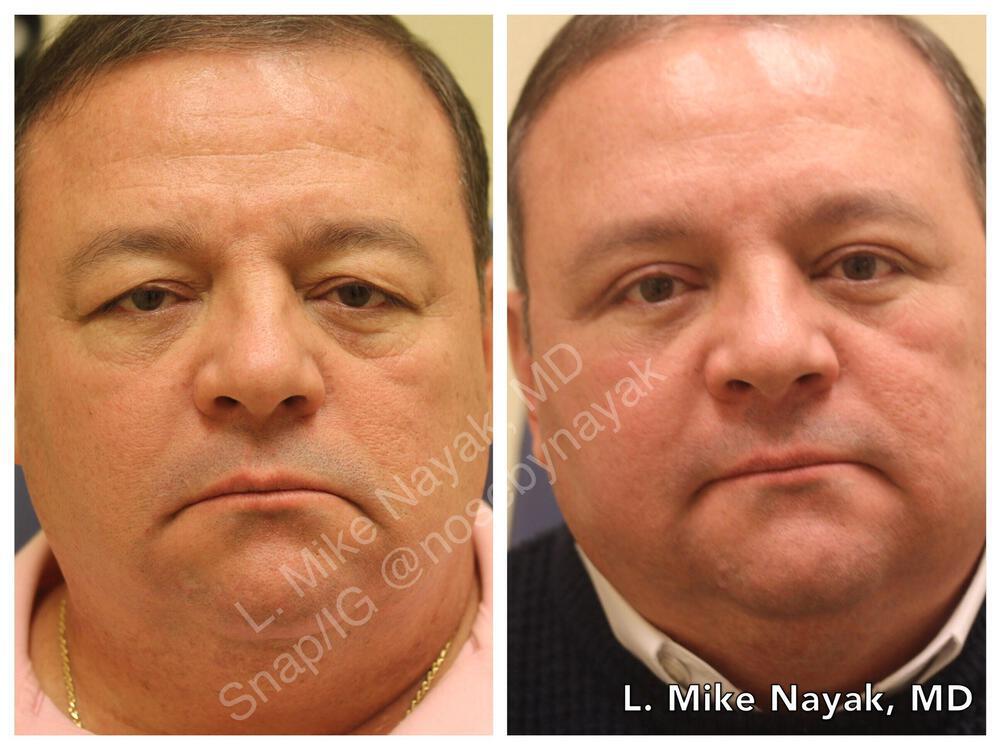 Blepharoplasty Before & After Image