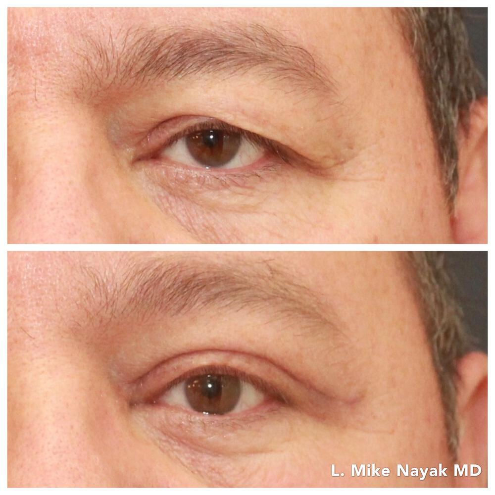 Blepharoplasty Before & After Image