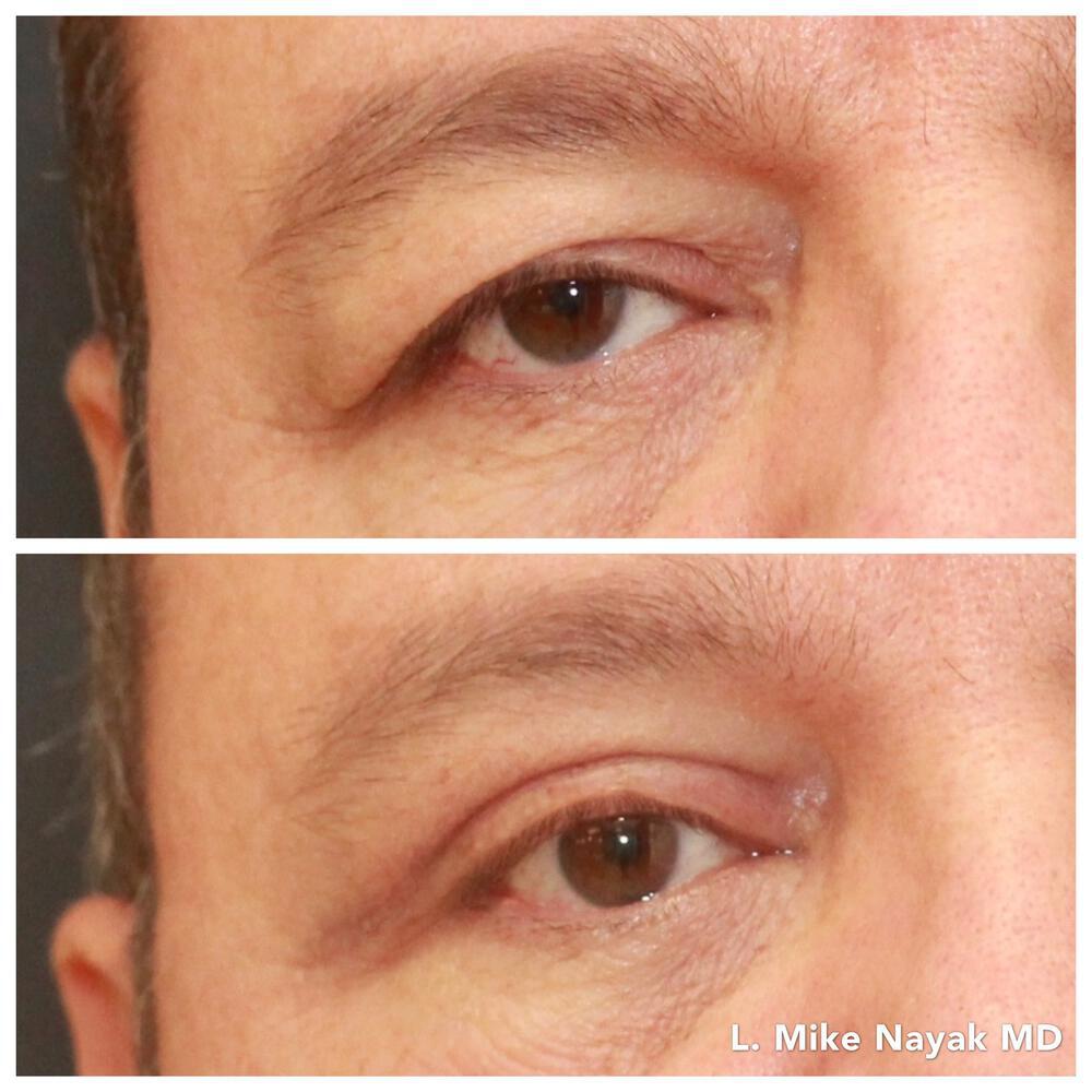 Blepharoplasty Before & After Image