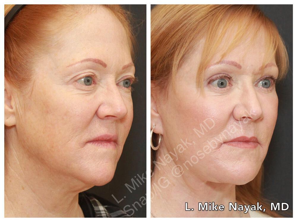 Blepharoplasty Before & After Image