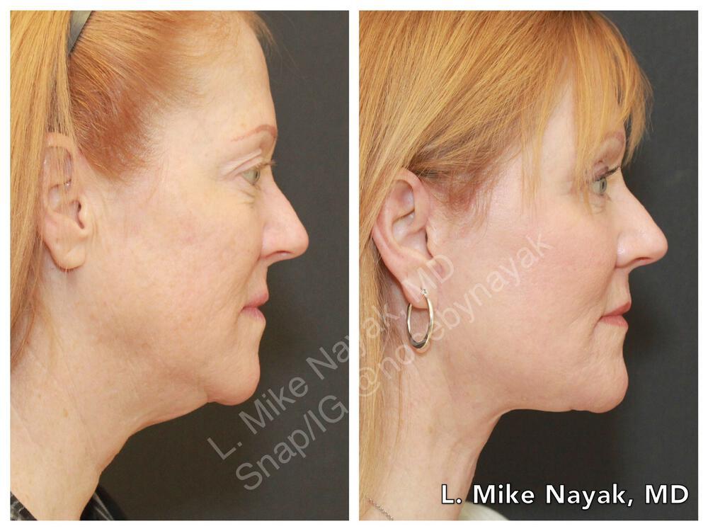 Blepharoplasty Before & After Image