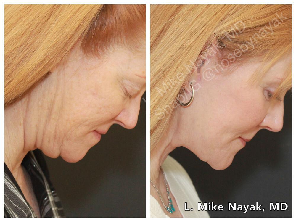 Blepharoplasty Before & After Image