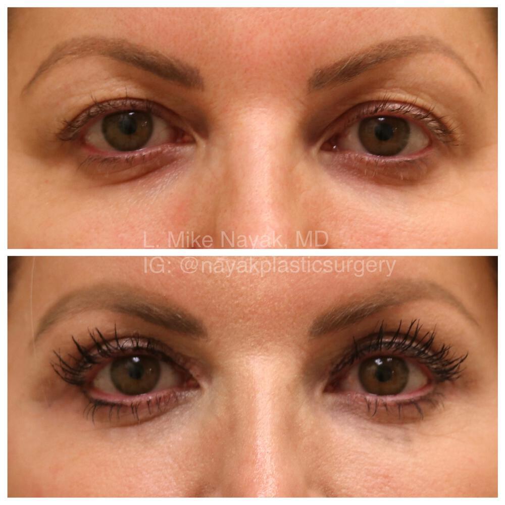 Blepharoplasty Before & After Image