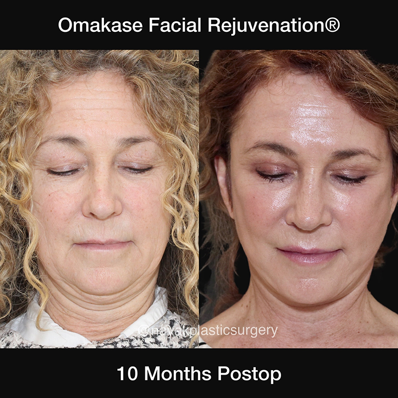 Blepharoplasty Before & After Image